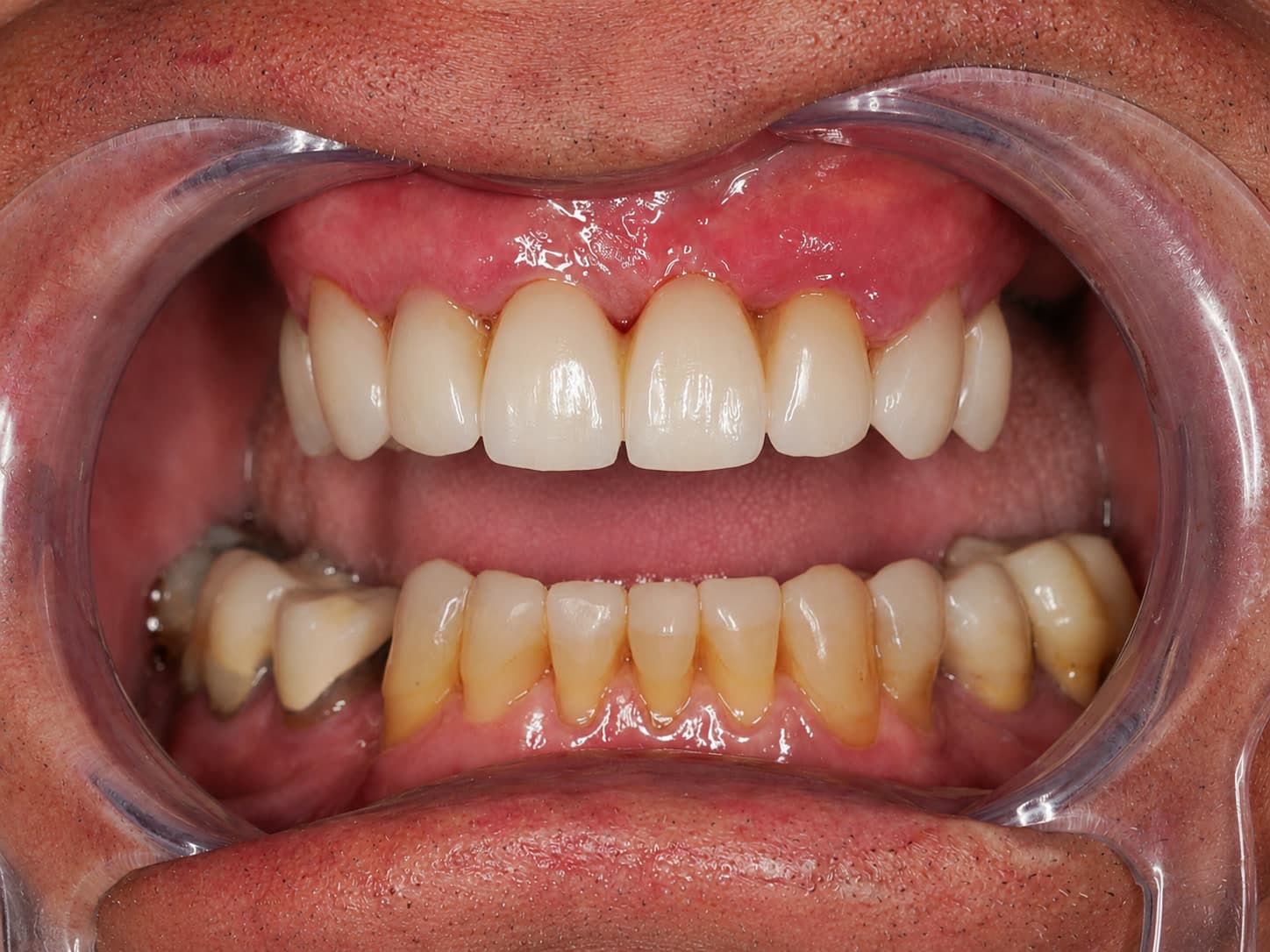 Retracted view of teeth after full mouth rehabilitation