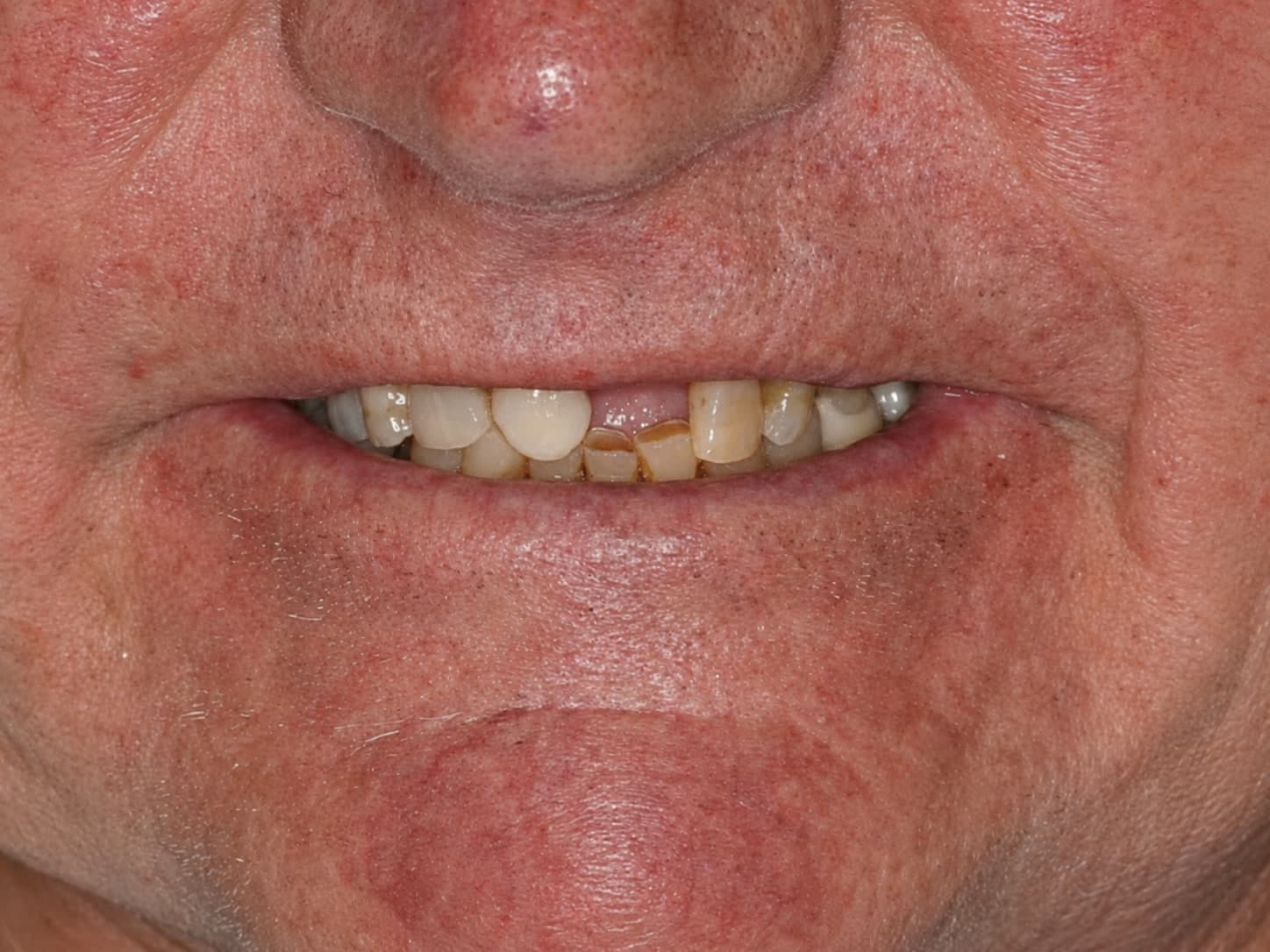 Patient before full mouth rehabilitation